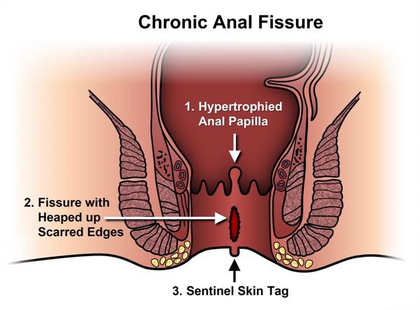 anal_fissure anal_fissure
