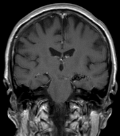 Arteriovenous Malformation Arteriovenous Malformation